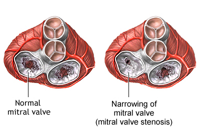 mitral-stenosis