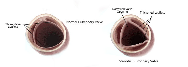 pulmonary_stenosis
