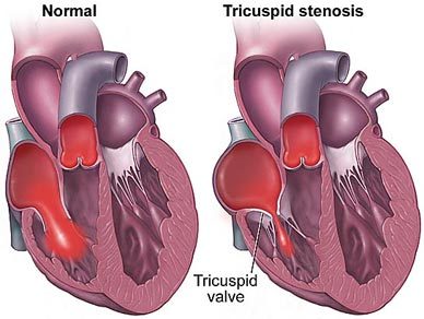 tricuspid_stenosis