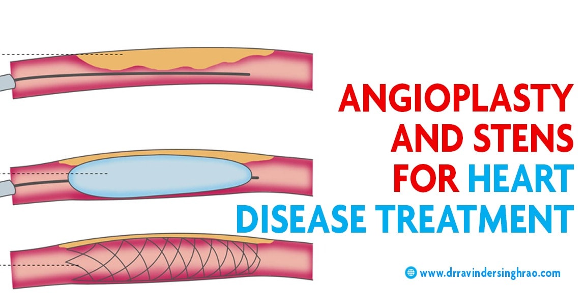 Coronary angioplasty and stents, Angioplasty and stent Placement