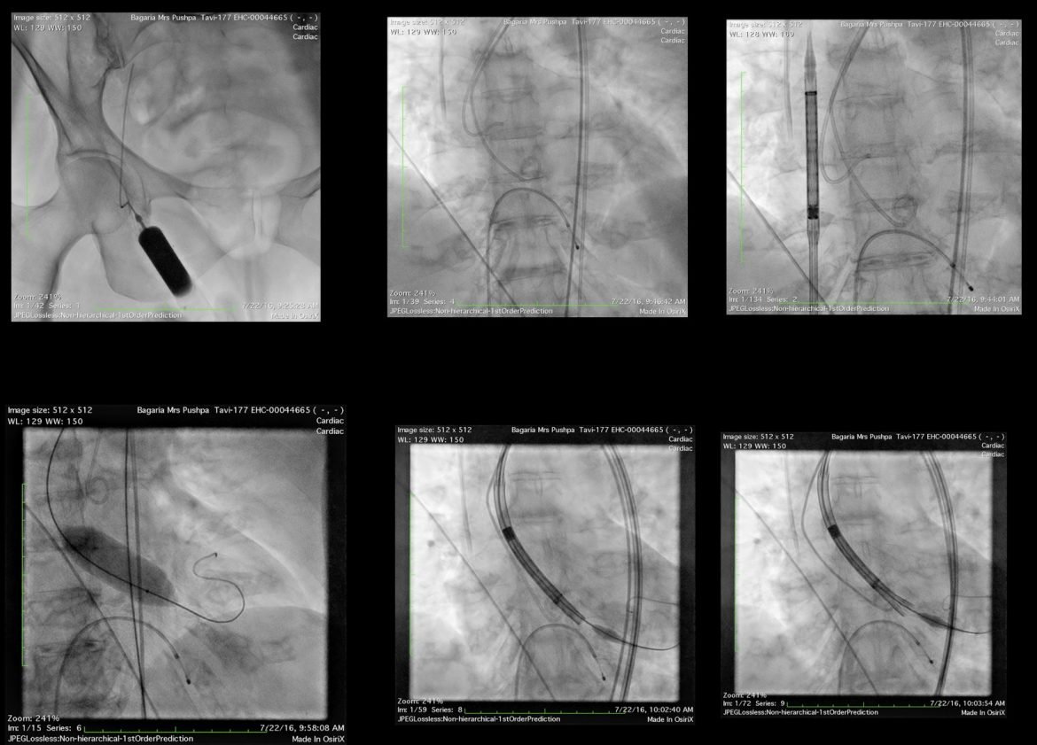 Know the TAVR Procedure Step-By-Step