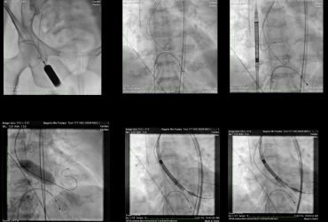 Know the TAVR Procedure Step-By-Step
