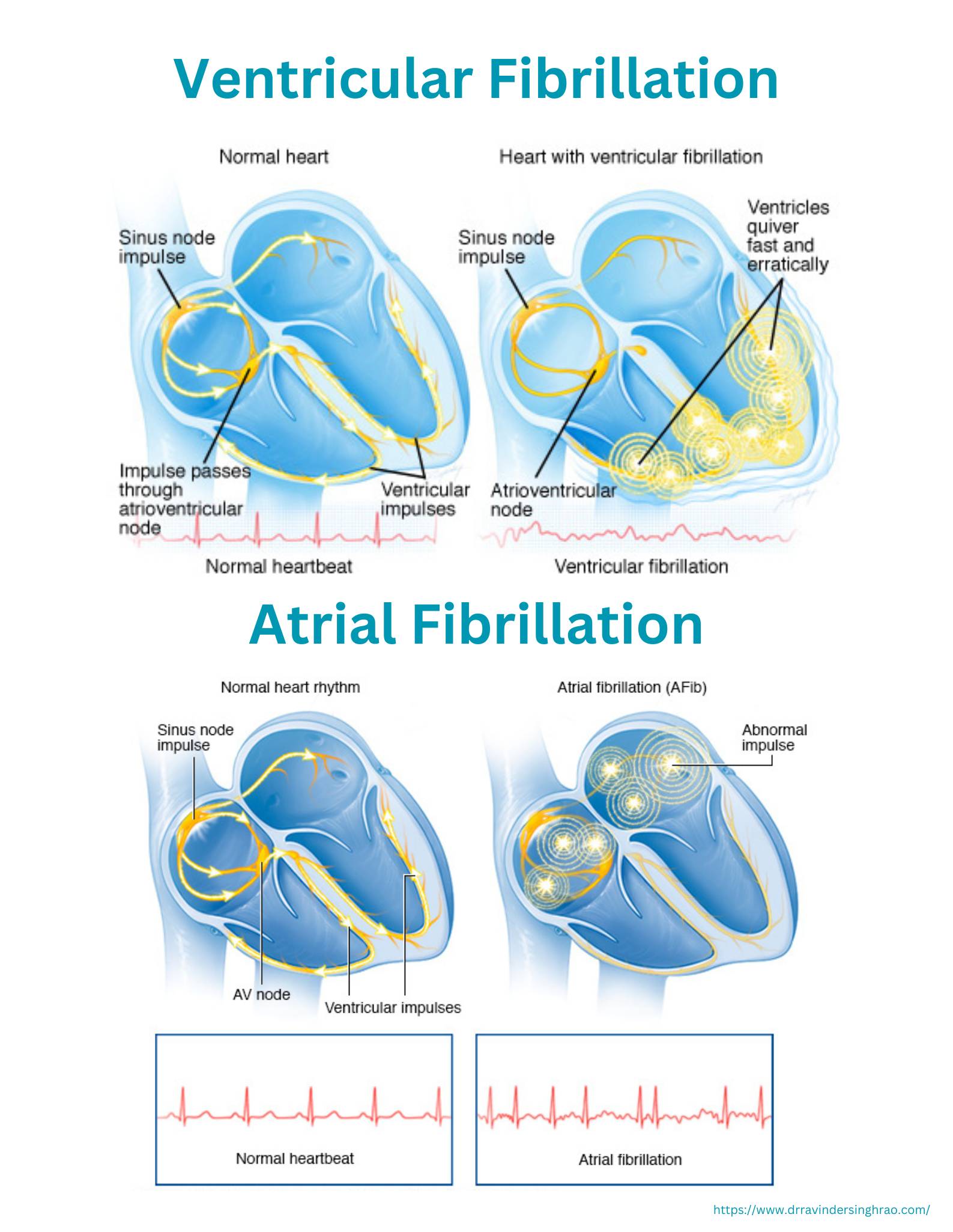 Causes of Heart Failure - Ventricular Fibrillation & Atrial Fibrillation