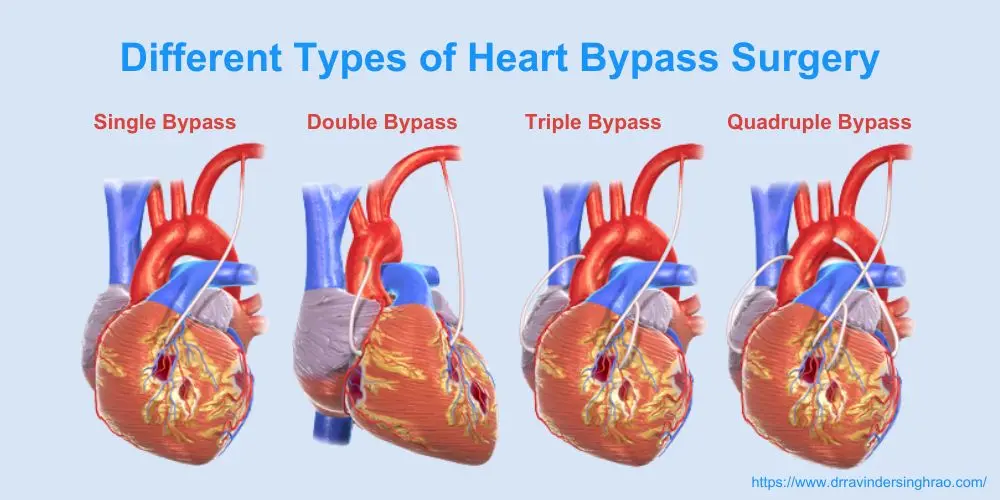 Different types of heart bypass surgery - Dr. Ravinder Singh Rao