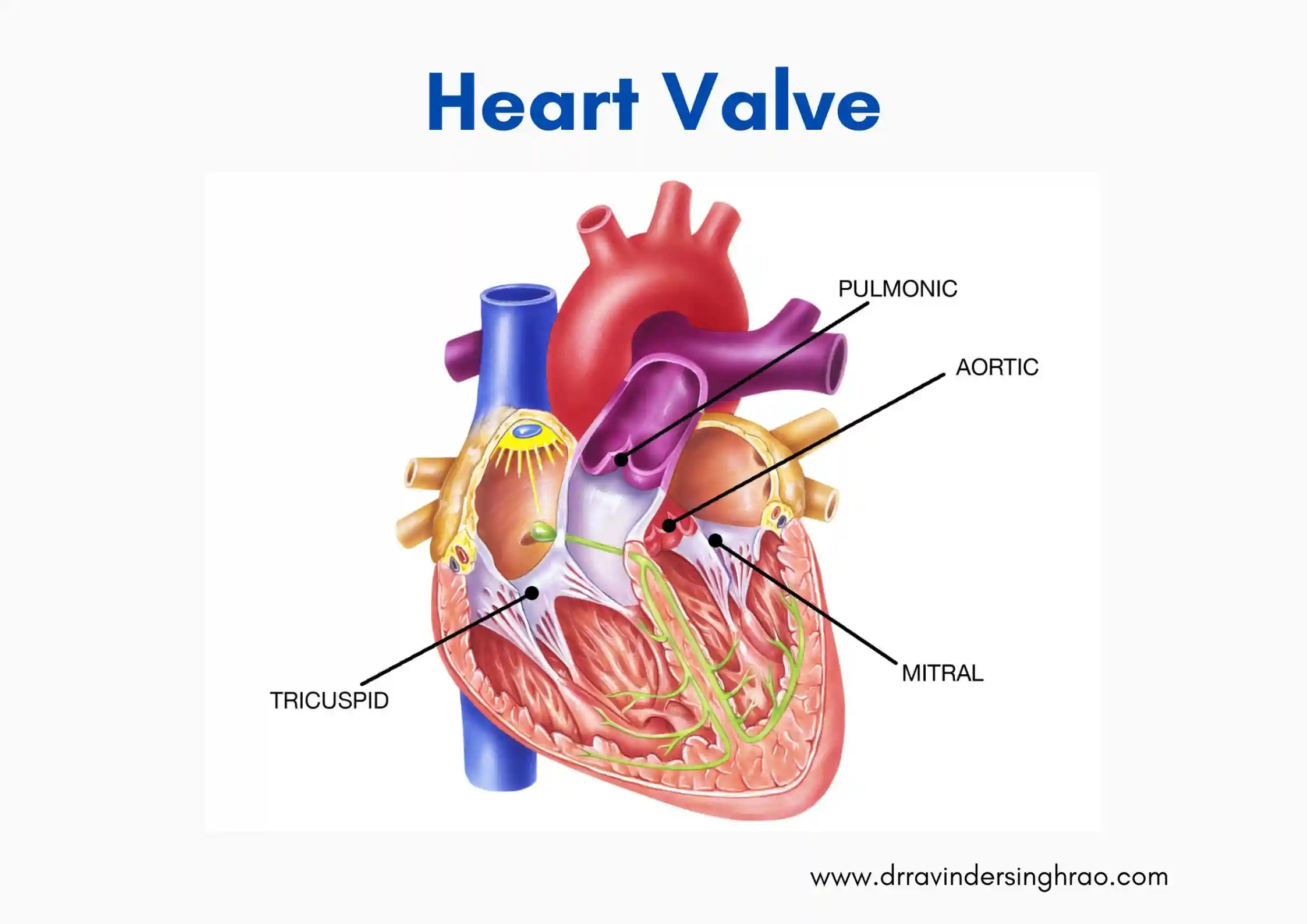 Heart Valve - Dr. Ravinder Singh Rao
