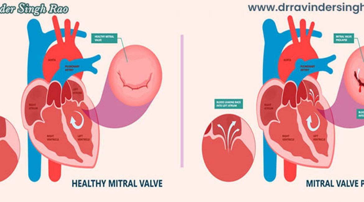 Best Heart Doctor of Mitral Valve | Best Mitral Valve Replacement Doctor in India