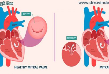 Best Heart Doctor of Mitral Valve | Best Mitral Valve Replacement Doctor in India