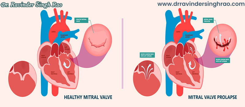 Best Heart Doctor of Mitral Valve | Best Mitral Valve Replacement Doctor in India