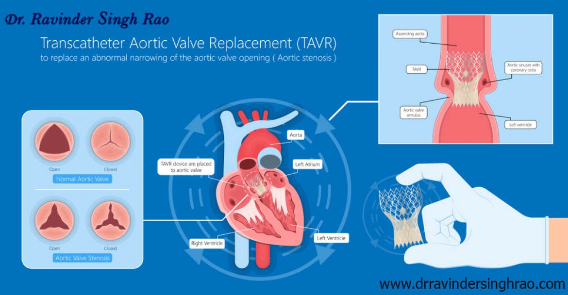 Transcatheter Mitral Valve Replacement (TMVR) expert in India