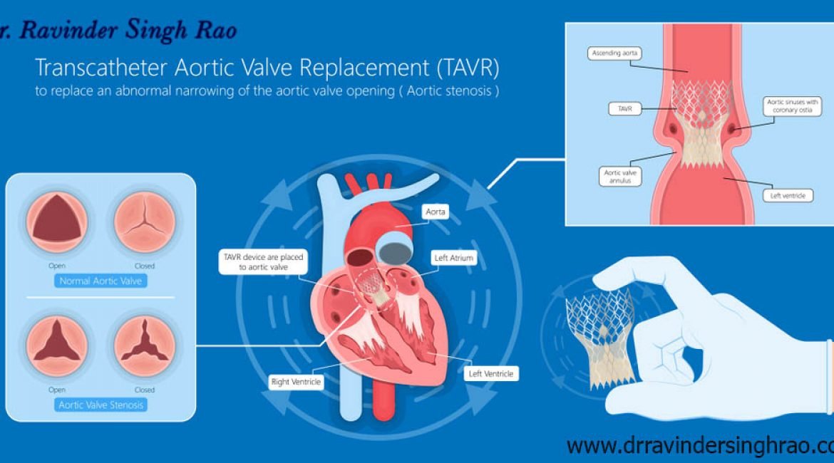 Transcatheter Mitral Valve Replacement (TMVR) expert in India