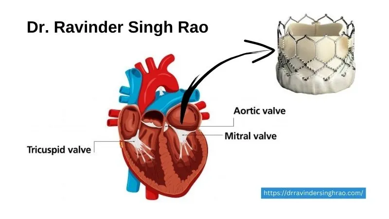 Transcatheter Mitral Valve Replacement - Dr. Ravinder Singh Rao