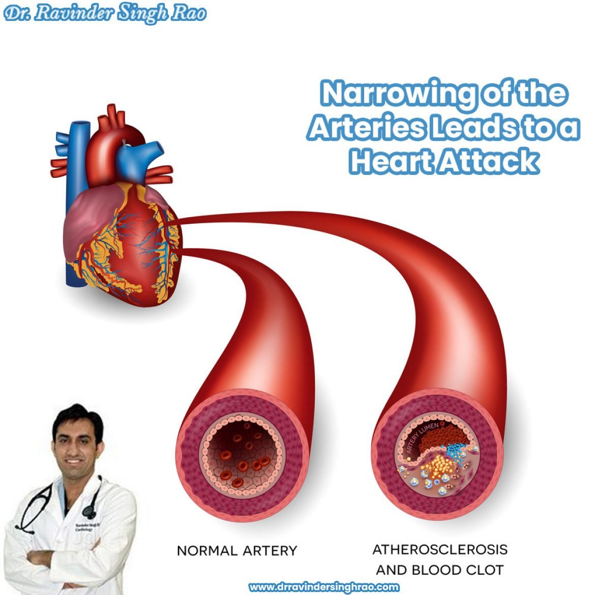 Narrowing Of The Arteries Leads To A Heart Attack