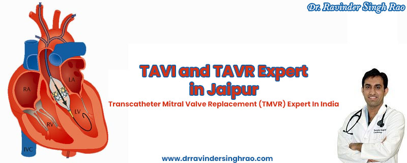 TAVI and TAVR Expert in India – Dr. Ravinder Singh Rao