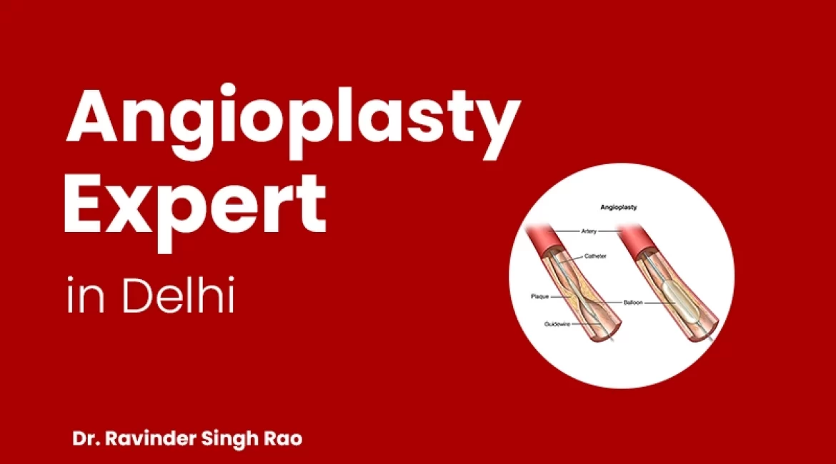 Best Angioplasty Expert in Delhi – Dr. Ravinder Singh Rao