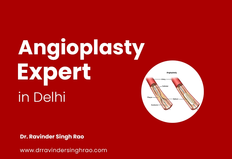 Best Angioplasty Expert in Delhi – Dr. Ravinder Singh Rao