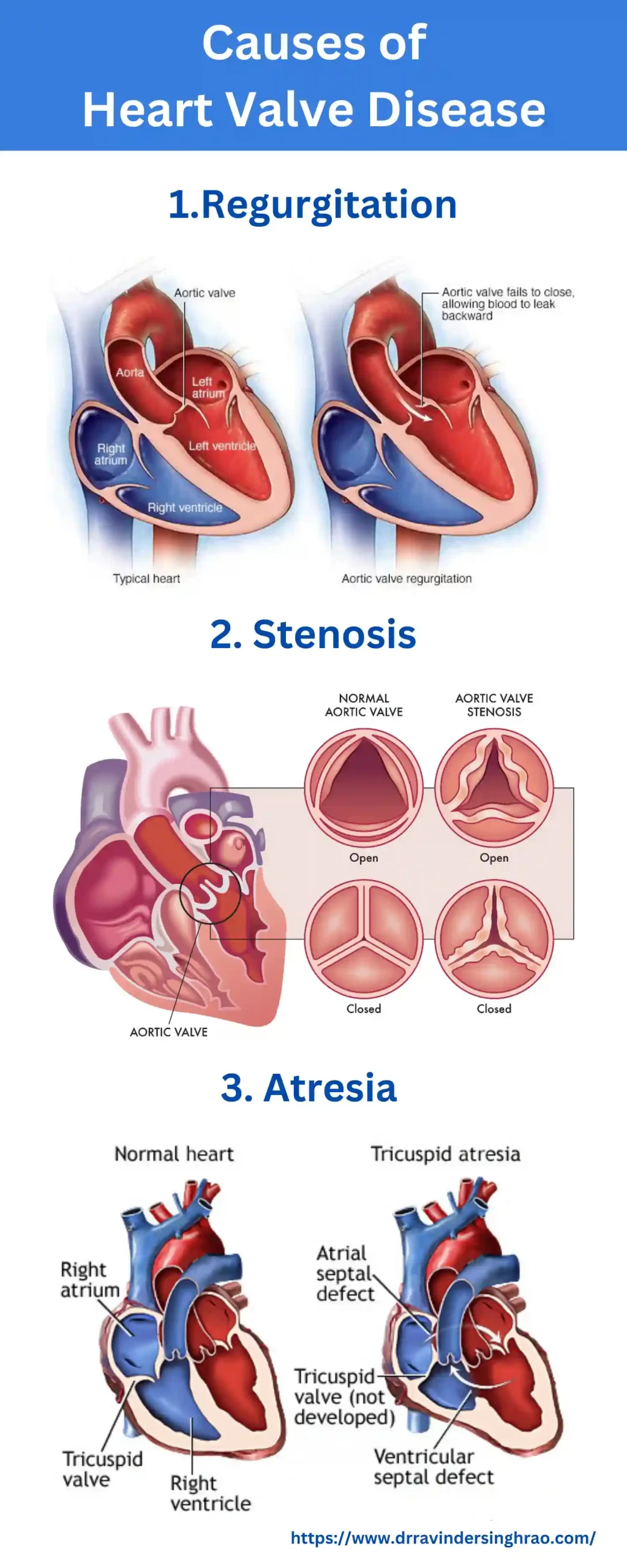 Causes of Heart Valve Disease - Dr. Ravinder Singh Rao