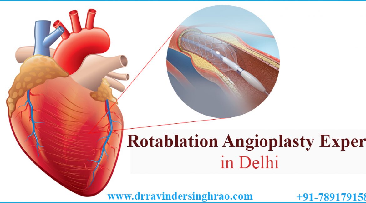 Rotablation Angioplasty Expert in Delhi | Angioplasty Expert in India