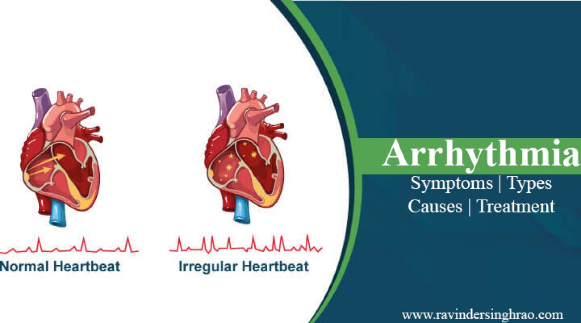 Arrhythmia: Types, Symptoms, Causes, Treatment and more