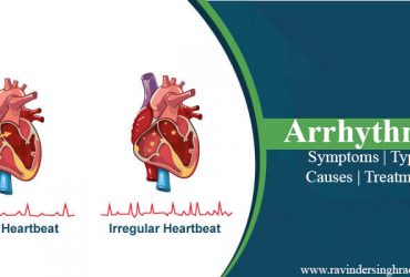 Arrhythmia: Types, Symptoms, Causes, Treatment and more