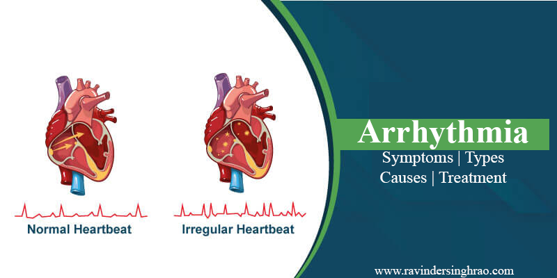 Is Arrhythmia is a Serious Disease? Symptoms | Types | Causes | Treatment