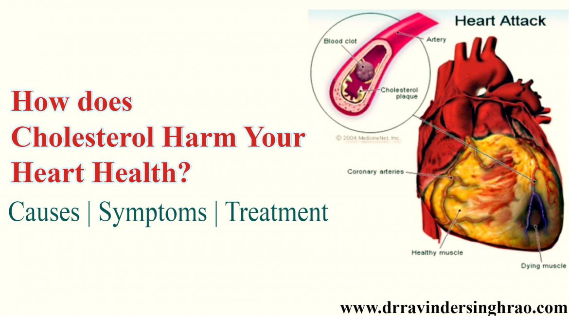 How does Cholesterol Harm Your Heart Health? Causes | Symptoms | Treatment