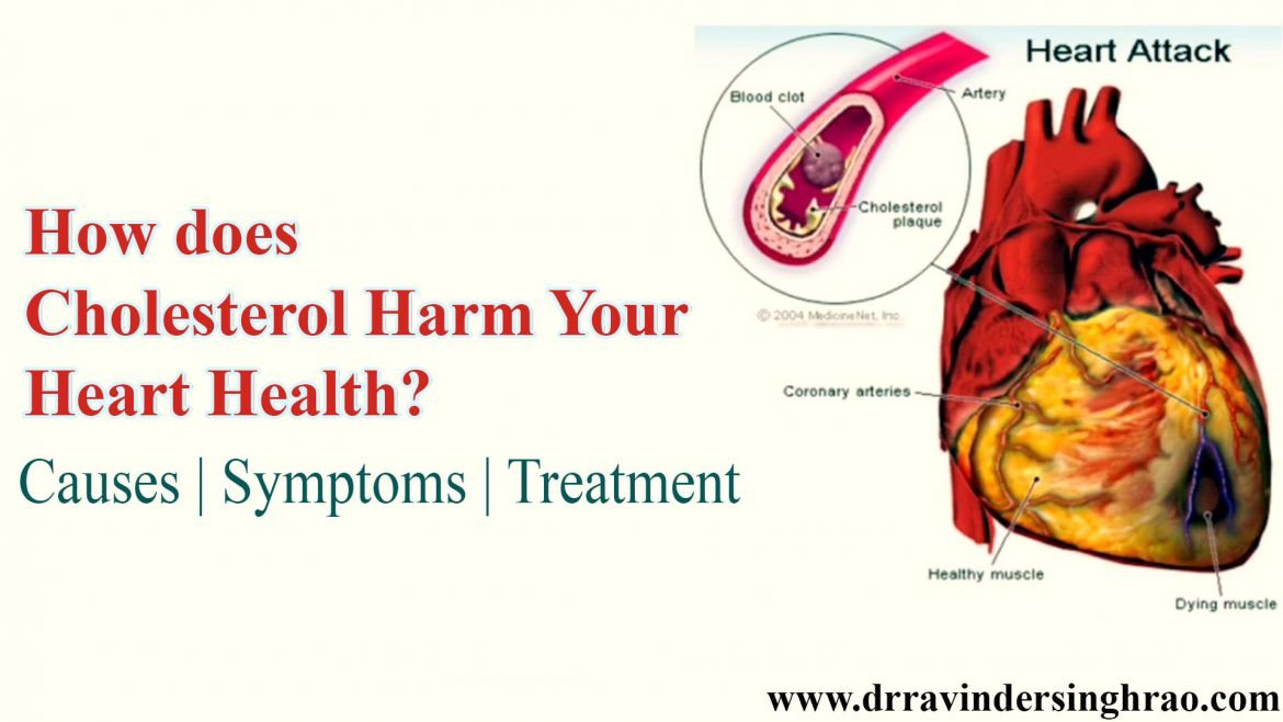 How does Cholesterol Harm Your Heart Health? Causes | Symptoms | Treatment