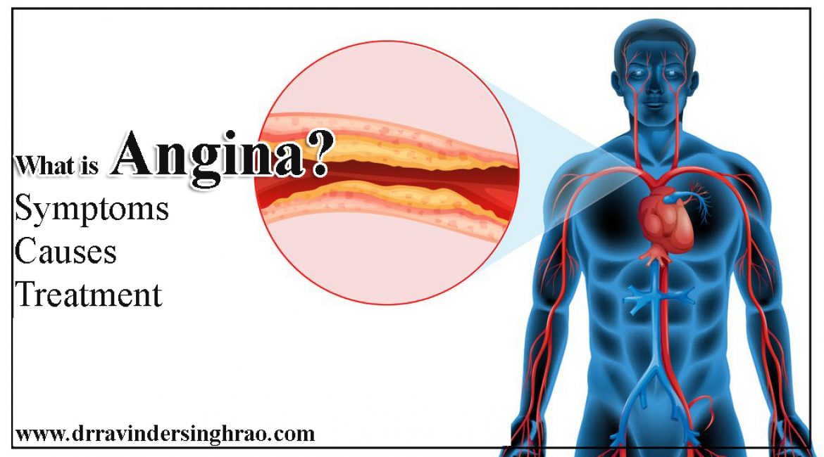 What is Angina? Symptoms, Causes & Treatment of Angina