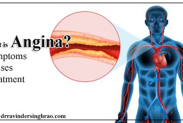 What is Angina? Symptoms, Causes & Treatment of Angina