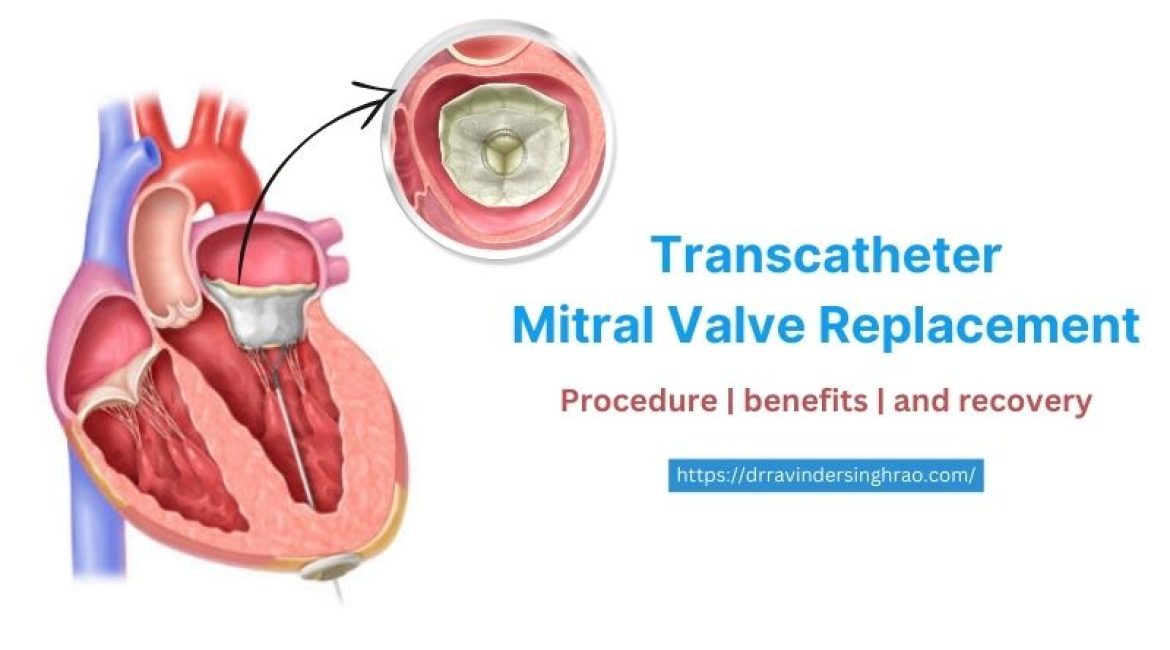 Transcatheter Mitral Valve Replacement (TMVR) – Procedure, benefits, and recovery