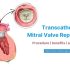 Transcatheter Mitral Valve Replacement (TMVR) – Procedure, benefits, and recovery
