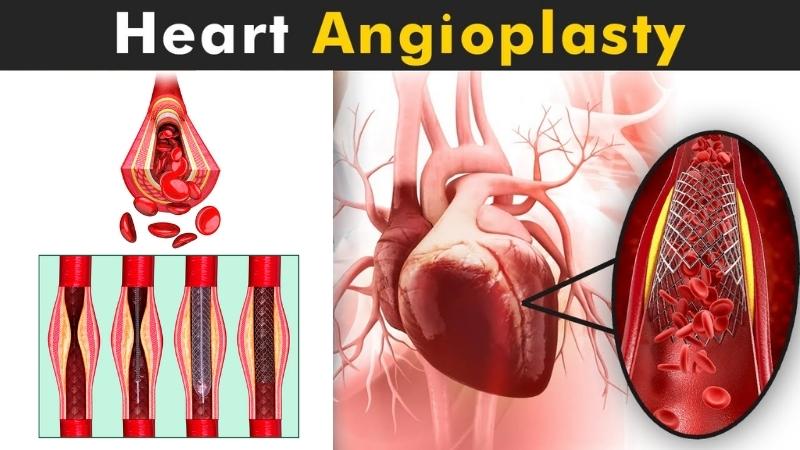 Angioplasty by Best Angioplasty Expert in India - Dr. Ravinder Singh Rao