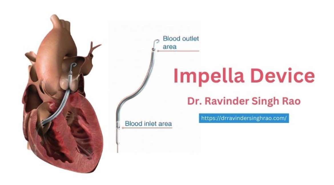 Impella Device | Impella Angioplasty Expert | Dr. Ravinder Singh Rao