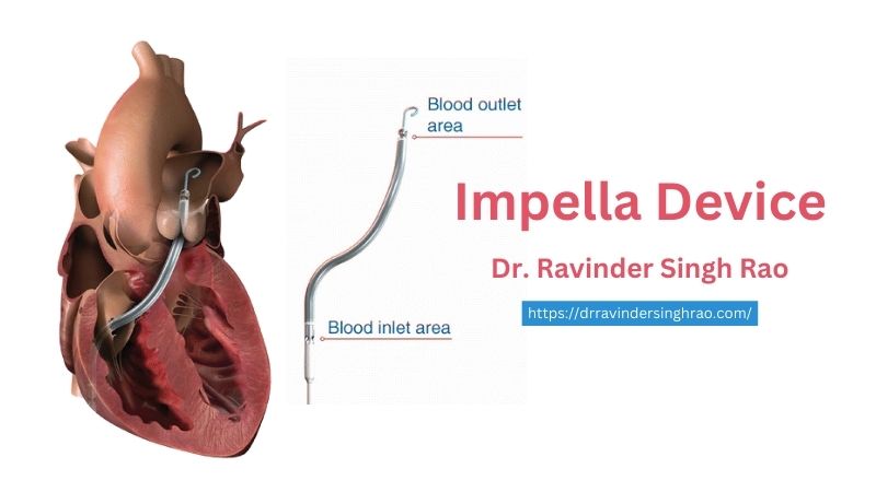 Impella Device | Impella Angioplasty Expert | Dr. Ravinder Singh Rao