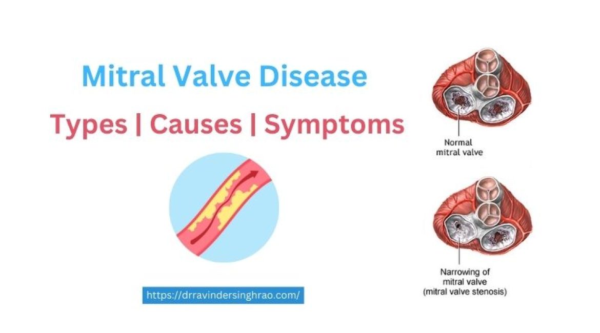 Mitral Valve Disease – Types, Causes and Symptoms