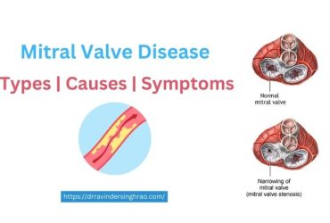 Mitral Valve Disease – Types, Causes and Symptoms