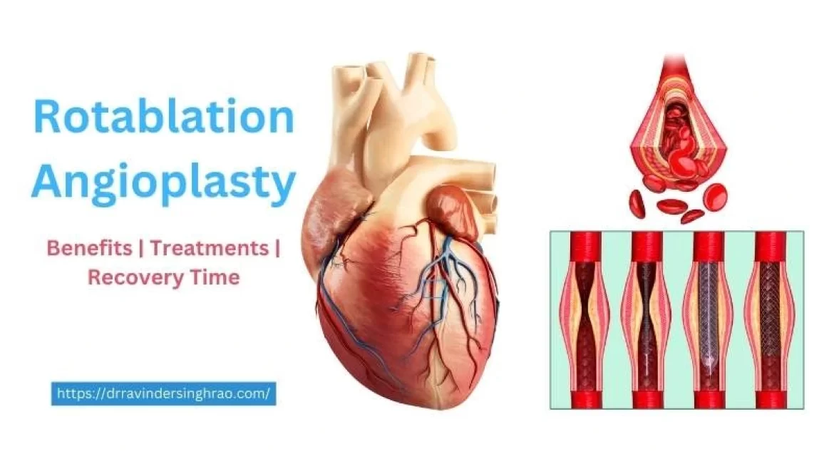 Rotablation Angioplasty – Benefits, Treatments, and Recovery Time