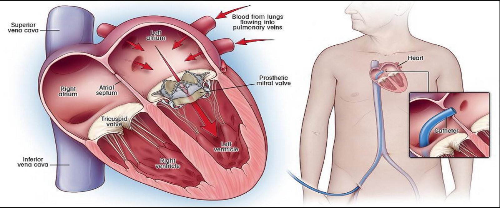 Mvr Radiograph Best Doctor for Transcatheter Mitral Valve Replacement TMVR, India