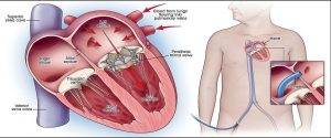 Transcatheter Mitral Valve Replacement TMVR Surgeon in India
