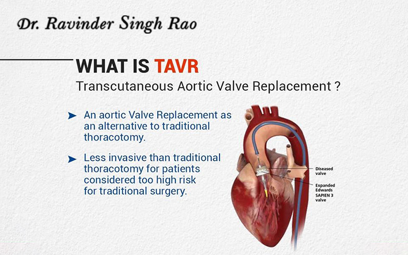 TAVR: Transcatheter Aortic Valve Replacement Without Open-Heart Surgery