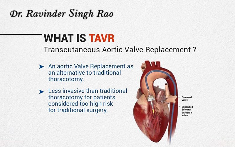 TAVR: Transcatheter Aortic Valve Replacement Without Open-Heart Surgery