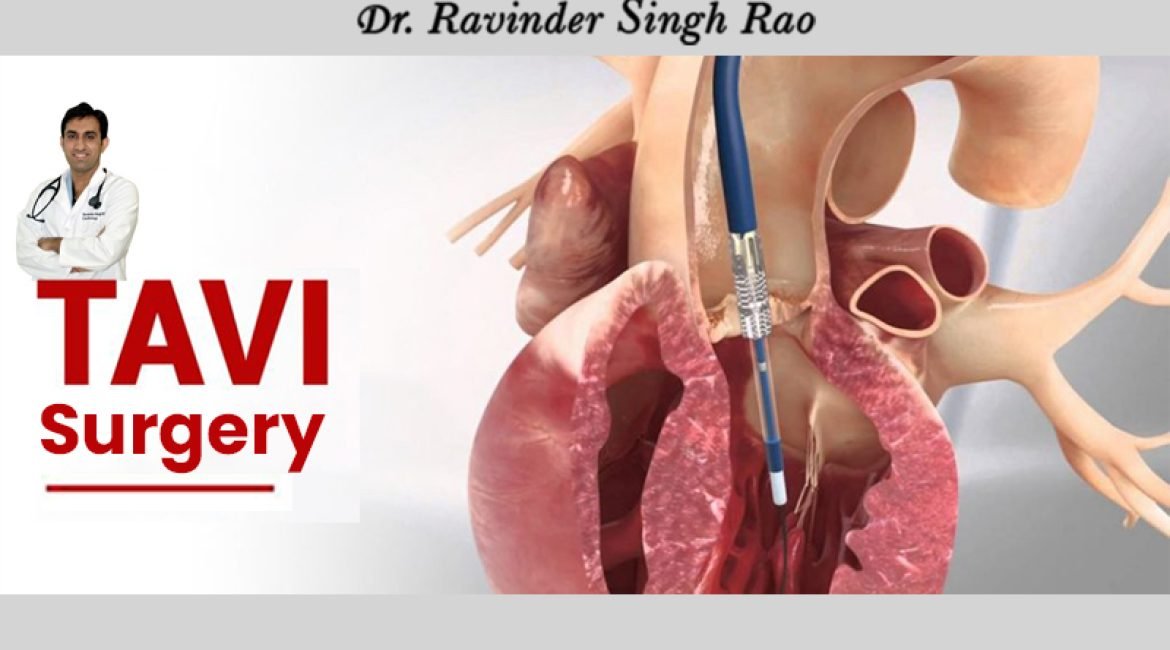 Top Cardiologist For TAVI Surgery in India