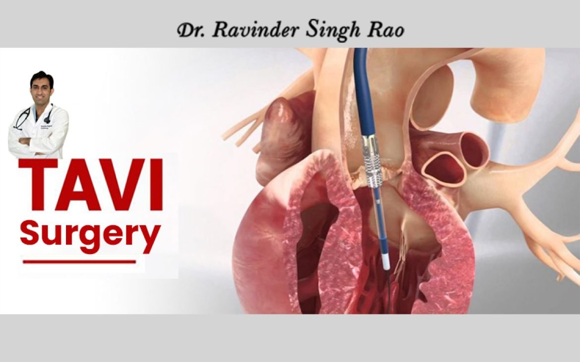 Top Cardiologist For TAVI Surgery in India