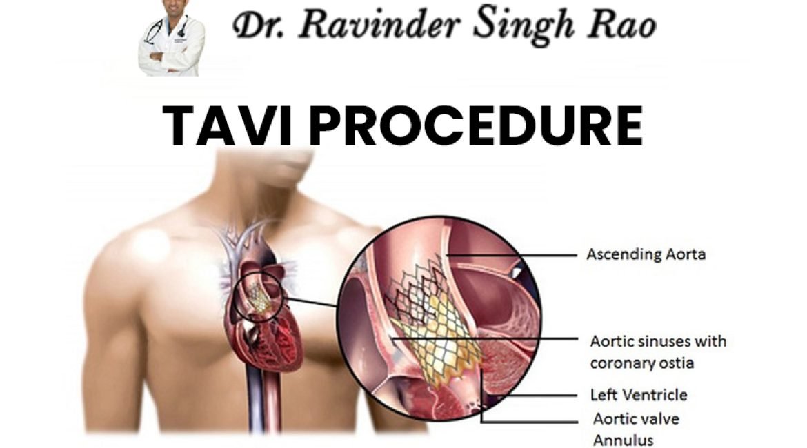 Transcatheter Aortic Valve Implantation Tavi Cardiologist In India