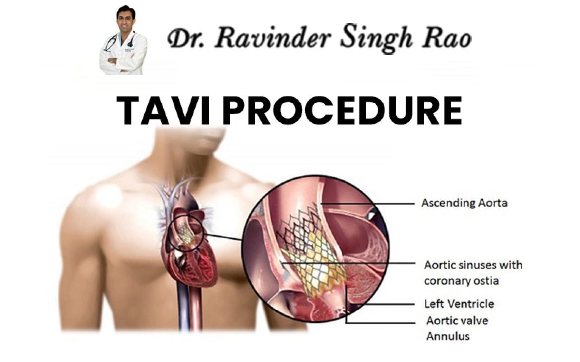 Transcatheter Aortic Valve Implantation Tavi Cardiologist In India