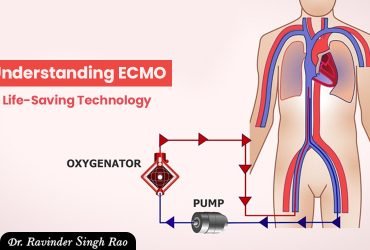 Understanding ECMO: A Life-Saving Technology