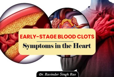 Early-Stage Blood Clots Symptoms in the Heart