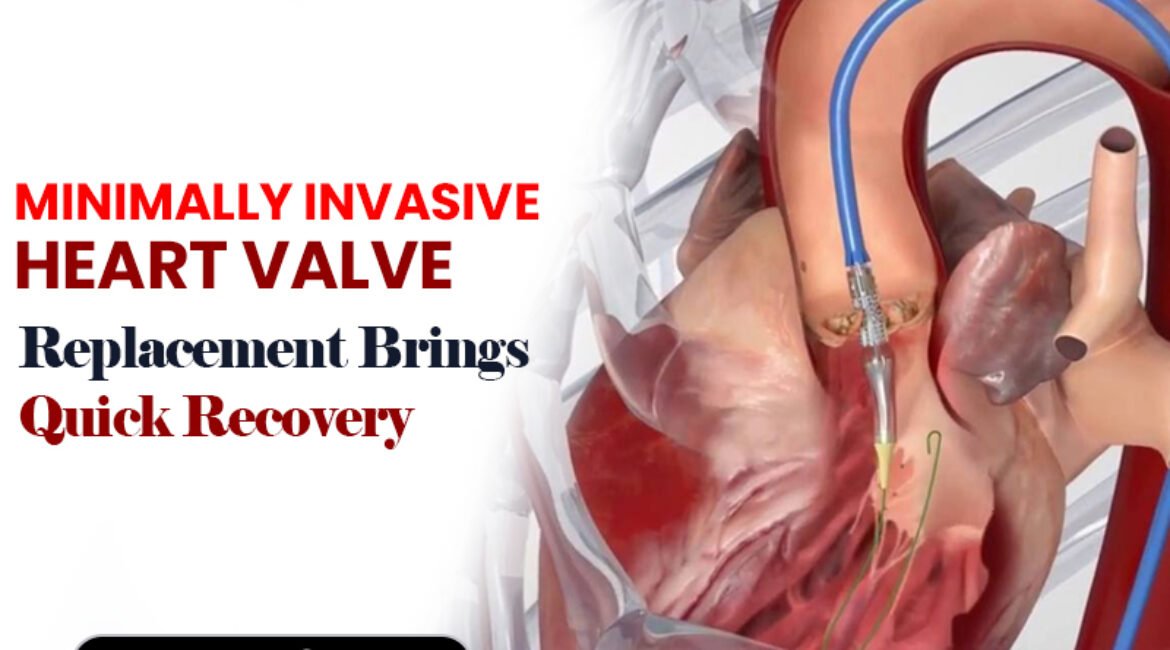 Minimally Invasive Heart Valve Replacement Brings Quick Recovery