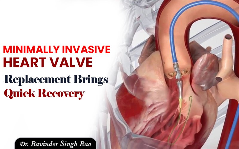 Minimally Invasive Heart Valve Replacement Brings Quick Recovery