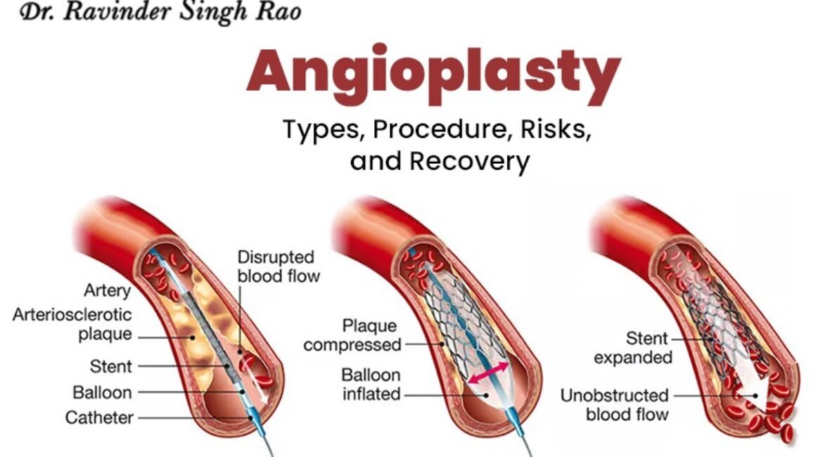 What is Angioplasty: Types, Procedure, Risks, and Recovery