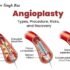 What is Angioplasty: Types, Procedure, Risks, and Recovery